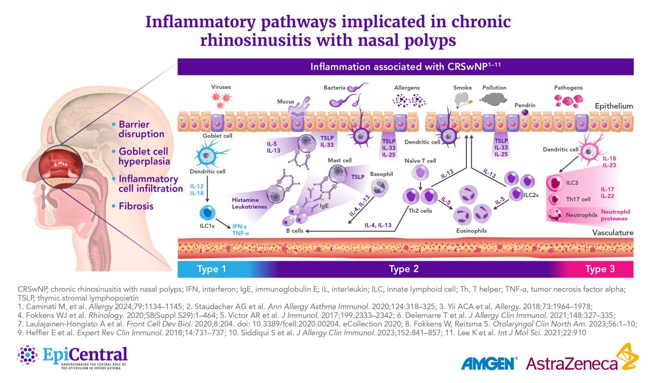 Inflammatory pathways implicated in chronic rhinosinusitis with nasal polyps