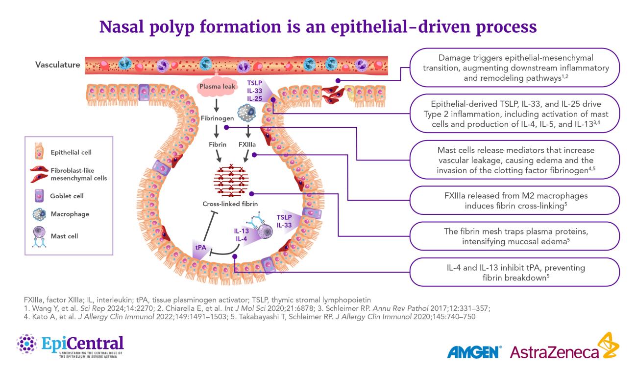 Nasal polyp formation is an epithelial-driven process