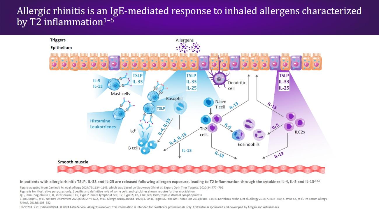 Allergic rhinitis is an IgE-mediated response to inhaled allergens characterized by T2 inflammation